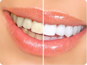 Photo: Dents avant et après blanchiment