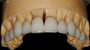Photo: Placages sur un modèle en plâtre