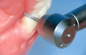 Photo: rotation des dents