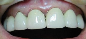 Photo: Cyanose de la marge gingivale