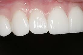 Photo: Facettes sur les dents de la mâchoire supérieure