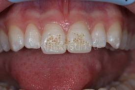 Photo: défauts des dents de devant