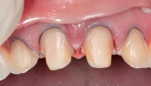 Photo: Préparation des dents sous les couronnes