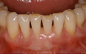 facettes sur les dents inférieures avant