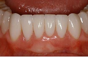 facettes sur les dents inférieures après