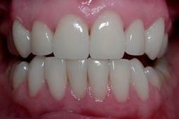 facettes sur les dents inférieures après 1