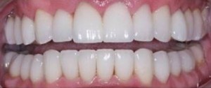 facettes sur les dents inférieures après