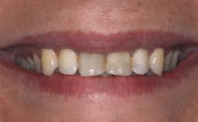 Photo: Taches sombres sur les dents