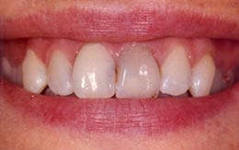 Photo: Assombrissement de l'émail des dents