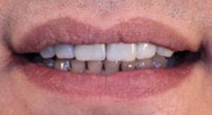 après l'installation sur les dents supérieures
