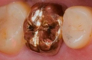 Photo: prothèses de couronne d'or