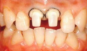 Dents avant tournant avec rebord