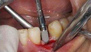 Photo: implantation