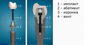 Photo: Fixation par vis d'une couronne sur un implant