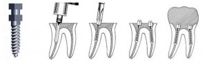 Photo: Restauration des dents avec une broche d'ancrage
