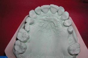 Foto: model de guix de dents