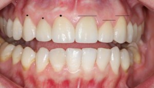 Photo: parfait état de la marge gingivale