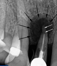 Foto: quist de dents sota la corona de la radiografia