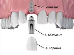 Photo: Couronne sur l'implant