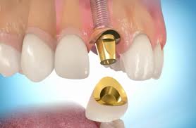 Photo: Couronne sur implants en capuchons métalliques