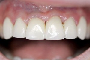 Photo: couronnes en zirconium après prothèses
