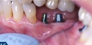Photo: couronnes sur implants avant pose
