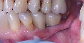 Photo: couronnes sur implants après prothèses