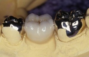 Photo: couronnes moulées en métal et cermets