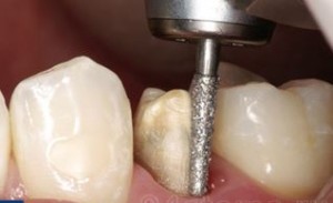 Foto: gir de dents
