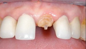 Photo: Restauration des dents avec une goupille en fibre de verre