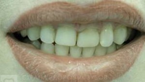 sourire avant le traitement