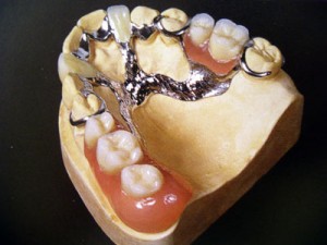 Photo: Prothèse à fermoir sur la mâchoire supérieure