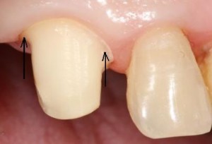 Photo: dent correctement affûtée
