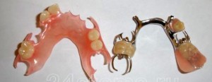 Photo: prothèses amovibles sur la mâchoire inférieure (nylon à gauche) et fermoir à droite)