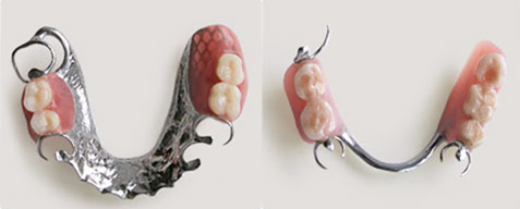 Photo: Prothèse à fermoir