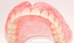 Photo: prothèse complète