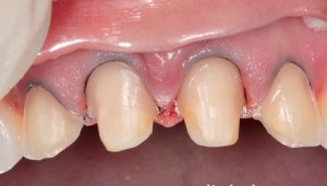 Photo: Dents avant avec rebord