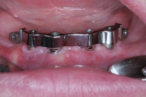 Photo: Fixation d'une prothèse amovible sur des verrous de type poutre