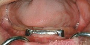 Photo: Prothèses sur implants avec verrouillage de faisceau
