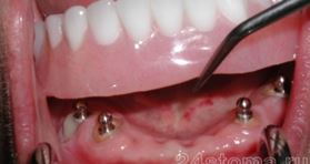 Photo: Fixation de la structure amovible aux implants