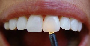Photo: Translucidité des couronnes