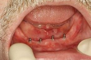 Photo: Après mini implantation