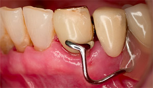 Photo: Fixation de prothèse de type Clammer