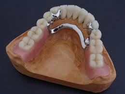 Photo: Prothèse à fermoir pour la mâchoire inférieure avec fixation de verrouillage