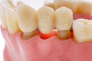 Photo: Denture