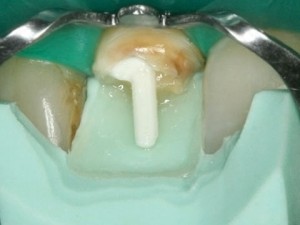 Photo: fixation d'une épingle en fibre de verre dans le canal radiculaire