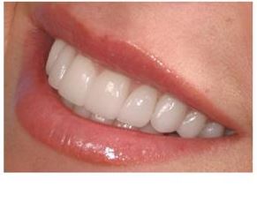 Photo: Dents après restauration avec des facettes