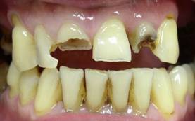 Photo: dent cariée par des caries