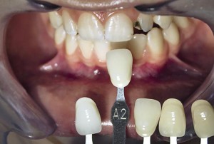 Photo: Dents de couleur assortie