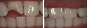 Photo: clivage des dents
